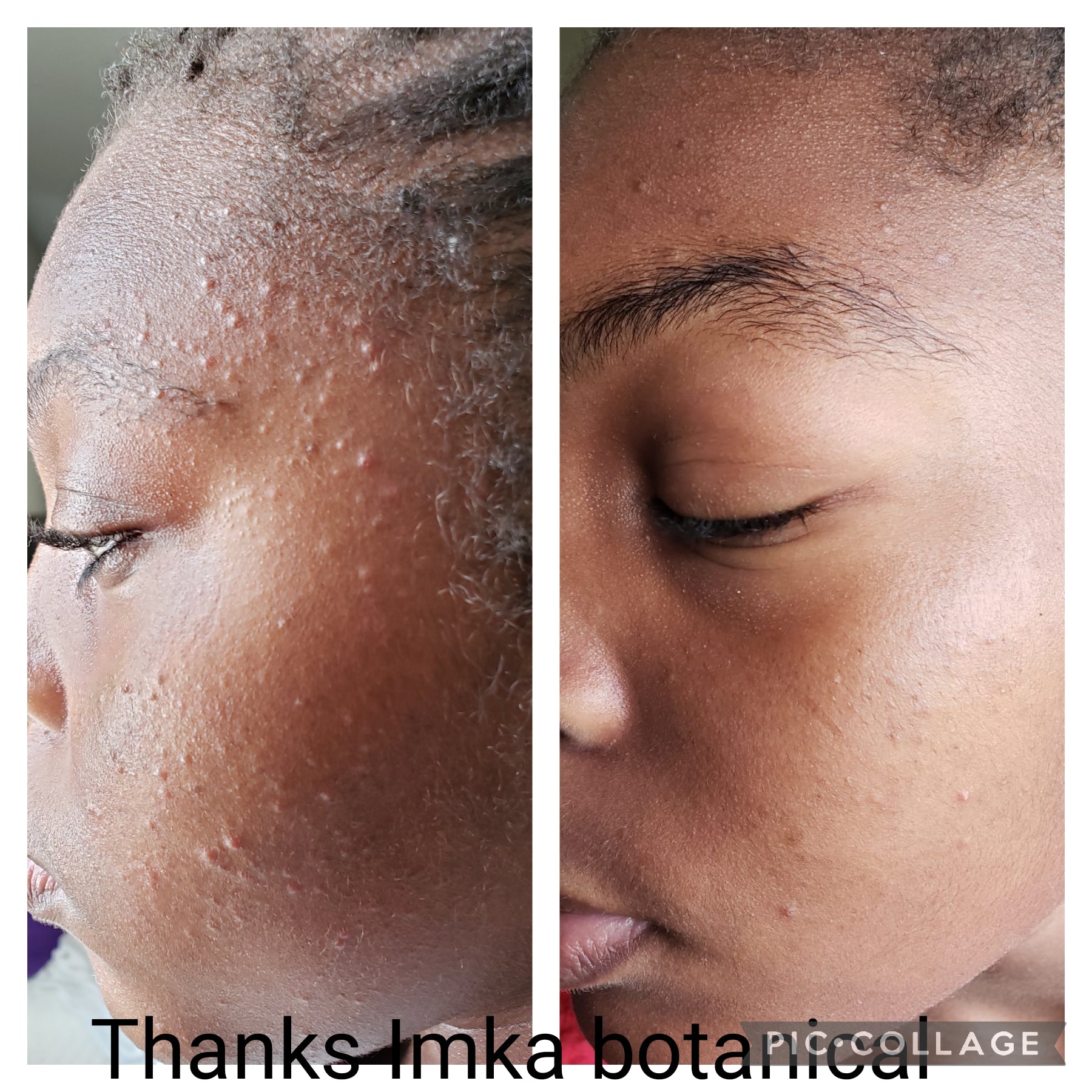 Best Acne Treatment - Clarify and Calm acne - prone skin - ShanShar Beauty : The world of beauty.