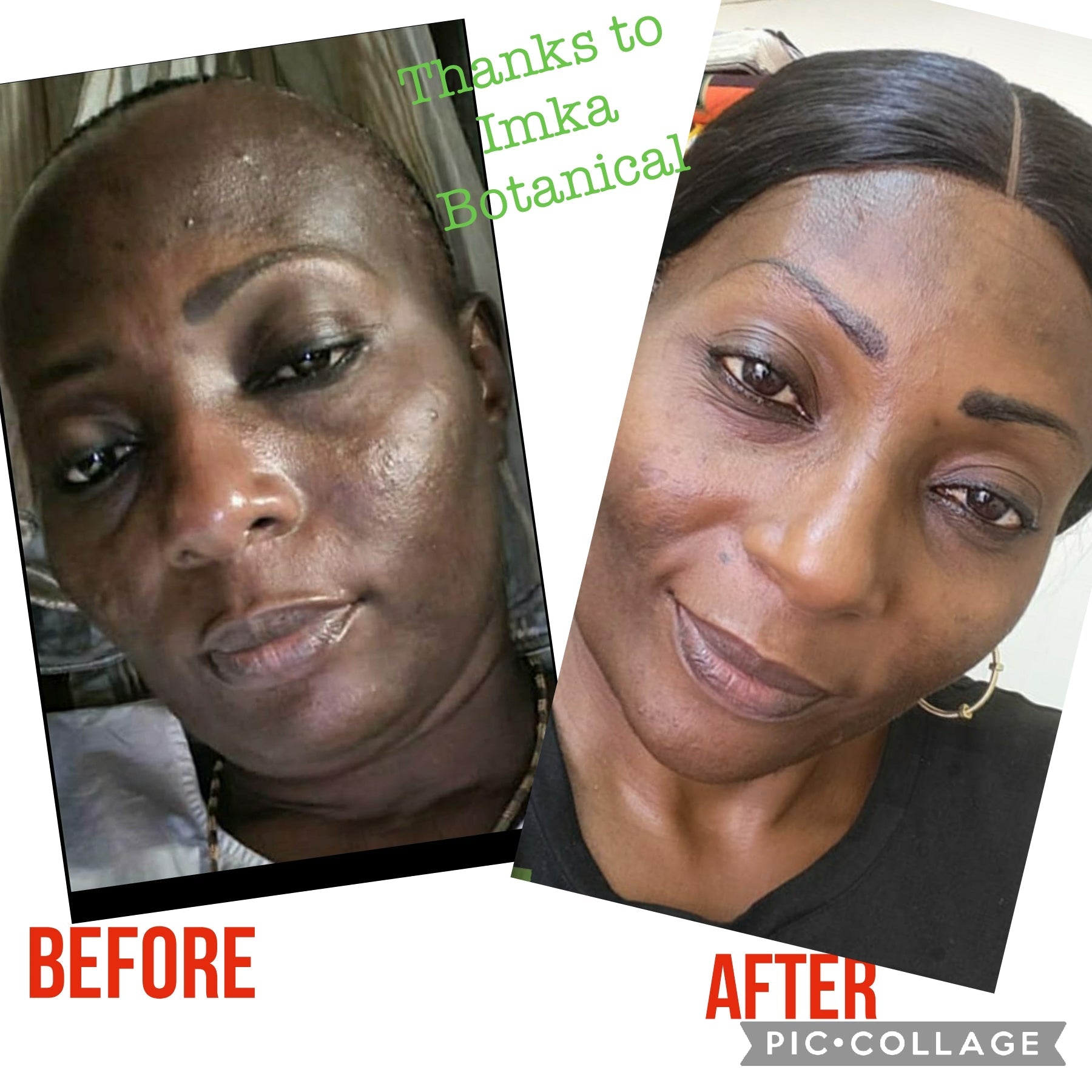 Jouvence Uneven tone, glowing & acne prone skin kit - ShanShar Beauty : The world of beauty.