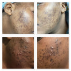 Meilleur traitement contre l'acné - Clarifier et calmer la peau à tendance acnéique