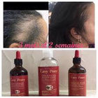 EASY POUSS - Anti-Hair Loss Treatment Serum, Hairline Treatment, Traction Alopecia Cure, Regrow your Edges. - ShanShar: The World Of Beauty